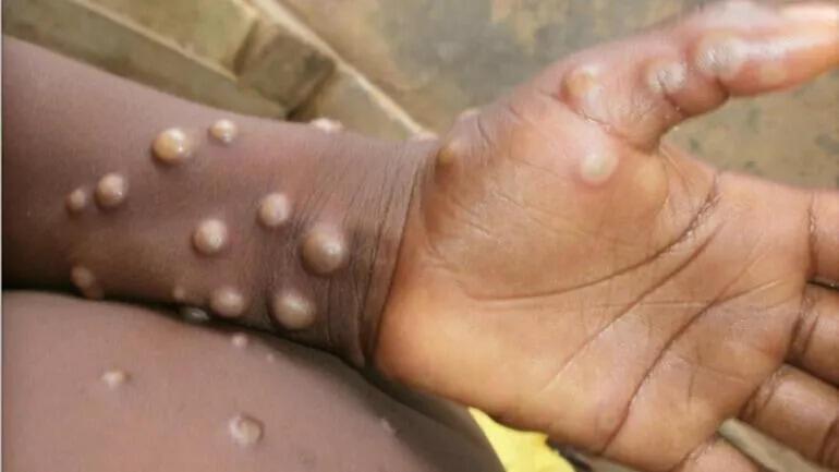 Spanish monkeypox outbreak linked to sauna - World News