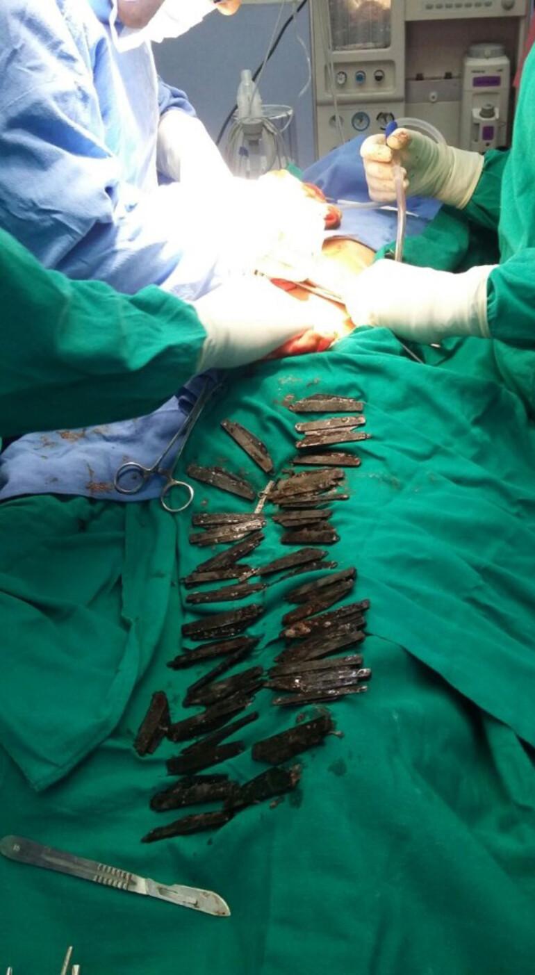 Doktorlar midesinden 40 tane bıçak çıkardı!